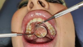 Complete Teeth Exam by the Dentist, Installation of Jewelry - HD - 11:30 video - from FapHouse