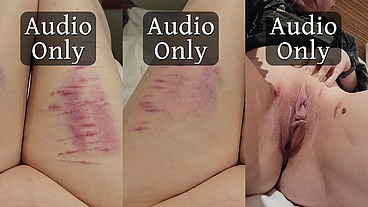 More pretty bruises and the story of how I got them - HD - 4:52 video - from Sheer